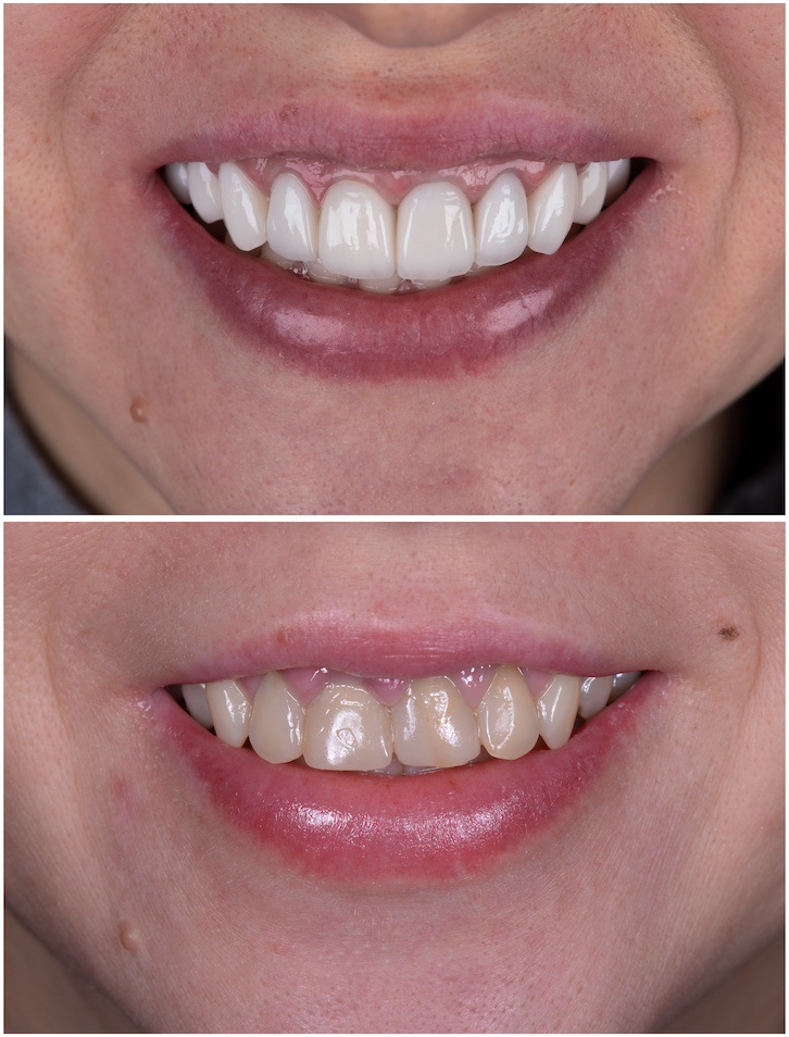 A woman's mouth showing before and after porcelain veneers