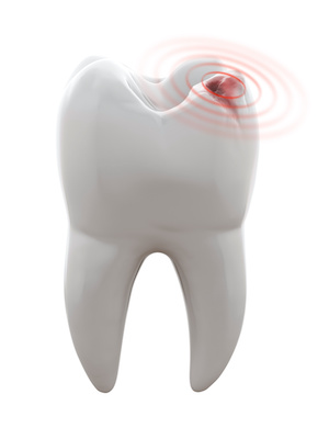3D illustration of tooth with cavity - Toothache
